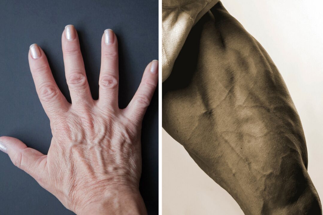 The symptoms of varicose veins