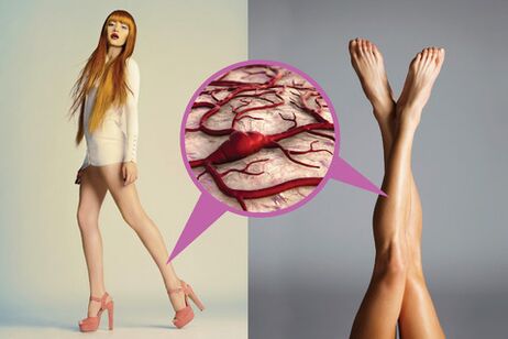 Varicose veins in the legs