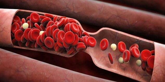 Preventing blood clots