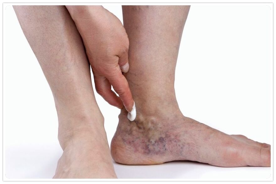 Benefits of the vein procedure