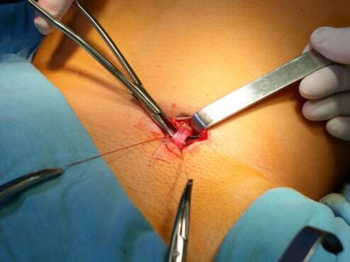 Flexolectomy