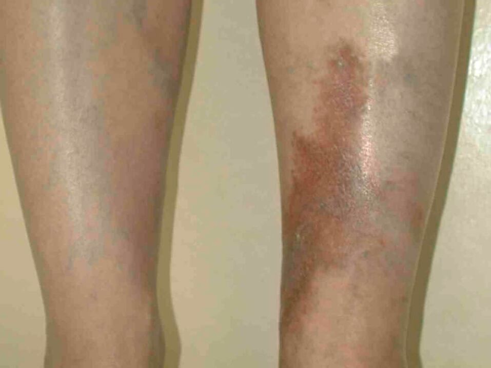 The phases of the vein with varicose