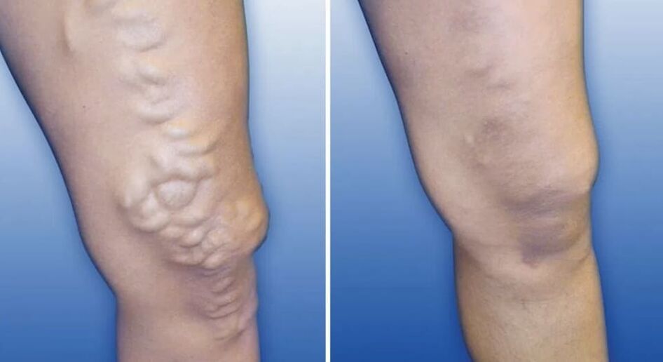 Varicose vein rate