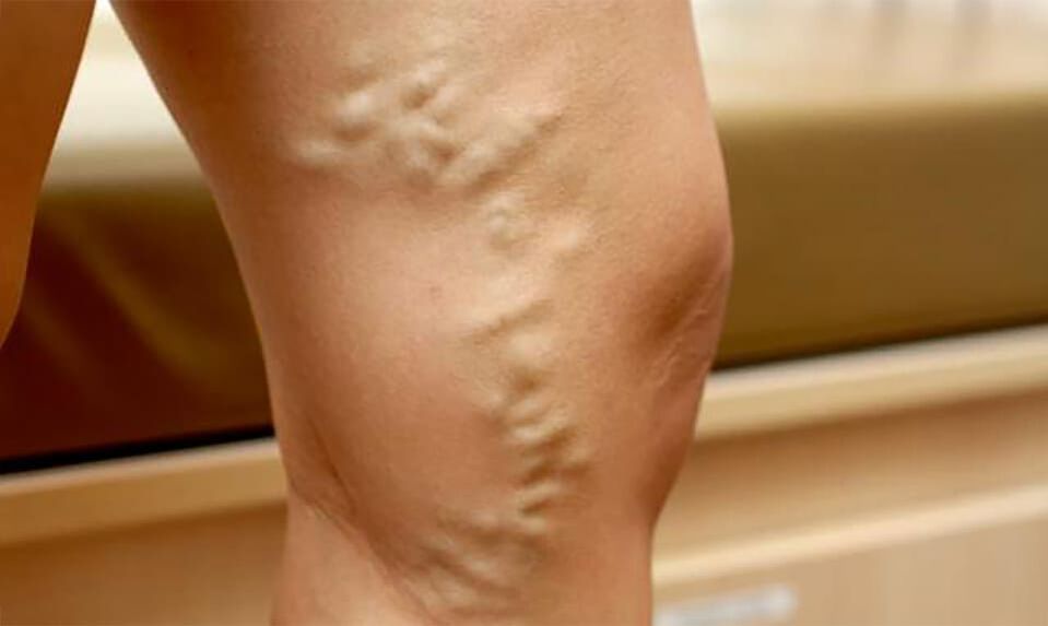 varicose veins in the legs