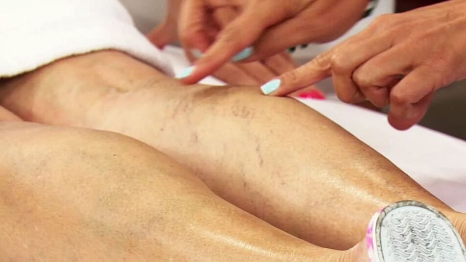 varicose veins in the lower leg