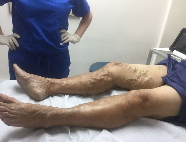 How to recognize a sign of varicose veins