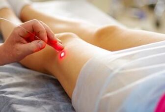 Laser treatment of varicose veins