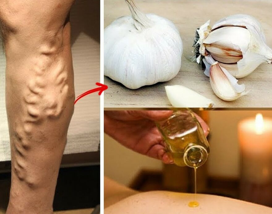 Varicose veins
