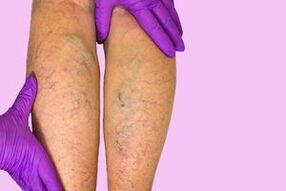 Varicose veins in the legs