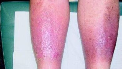 The third stage of varicose veins in the legs