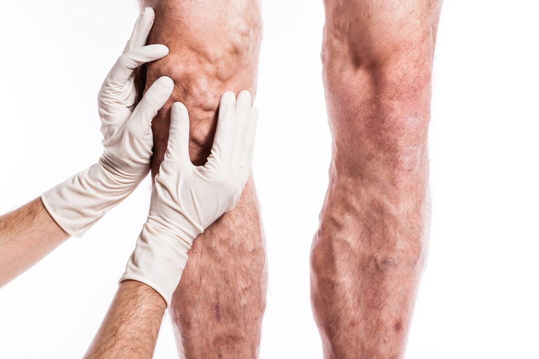 The phlebologist examines the legs of a patient with varicose veins