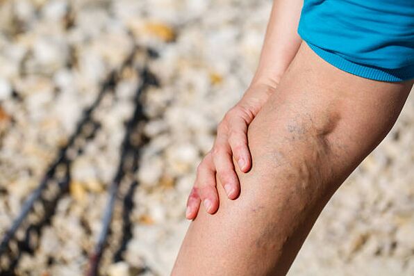 varicose veins of the legs