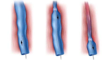 Radiofrequency ablation is a method for treating varicose veins