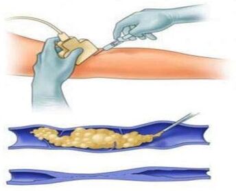 Sclerotherapy is a method for treating varicose veins