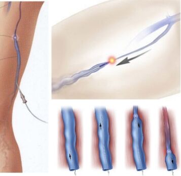 method of treating varicose veins - endovenous laser coagulation