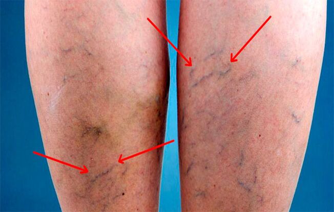 Elongated veins in the legs with varicose veins