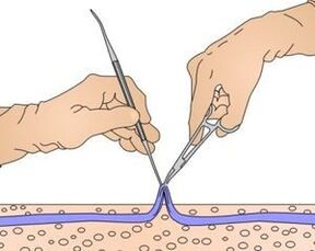 Miniflebectomy - removal of the part of the vein affected by varicose veins