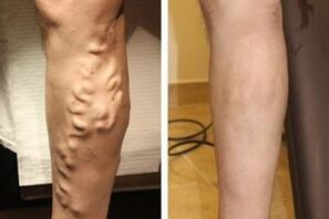 The result of the operation for the elimination of varicose veins of the legs