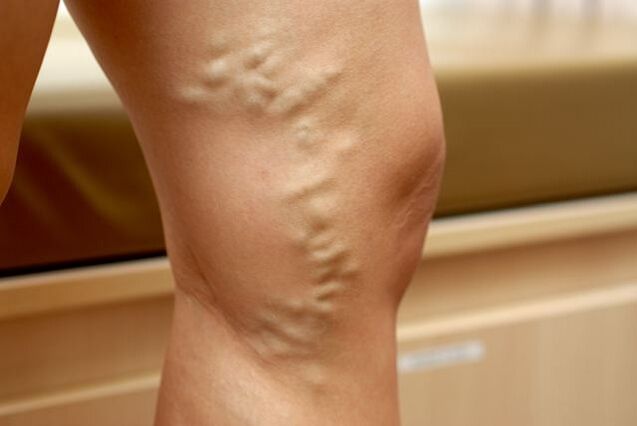 Deformed vein extending to the leg with stage 3 varicose veins