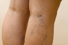 photo of varicose veins in the legs